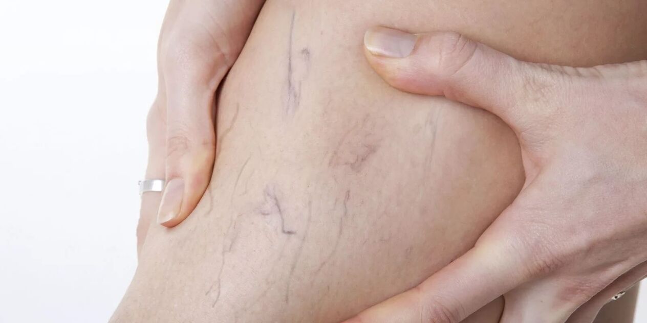 Prije upotrebe varikonske kreme